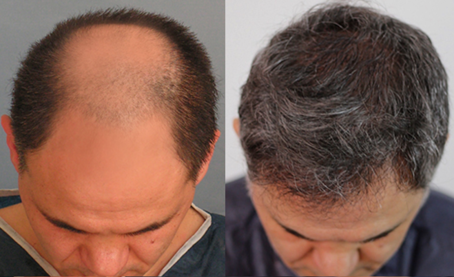 durée greffe de cheveux  avant apres