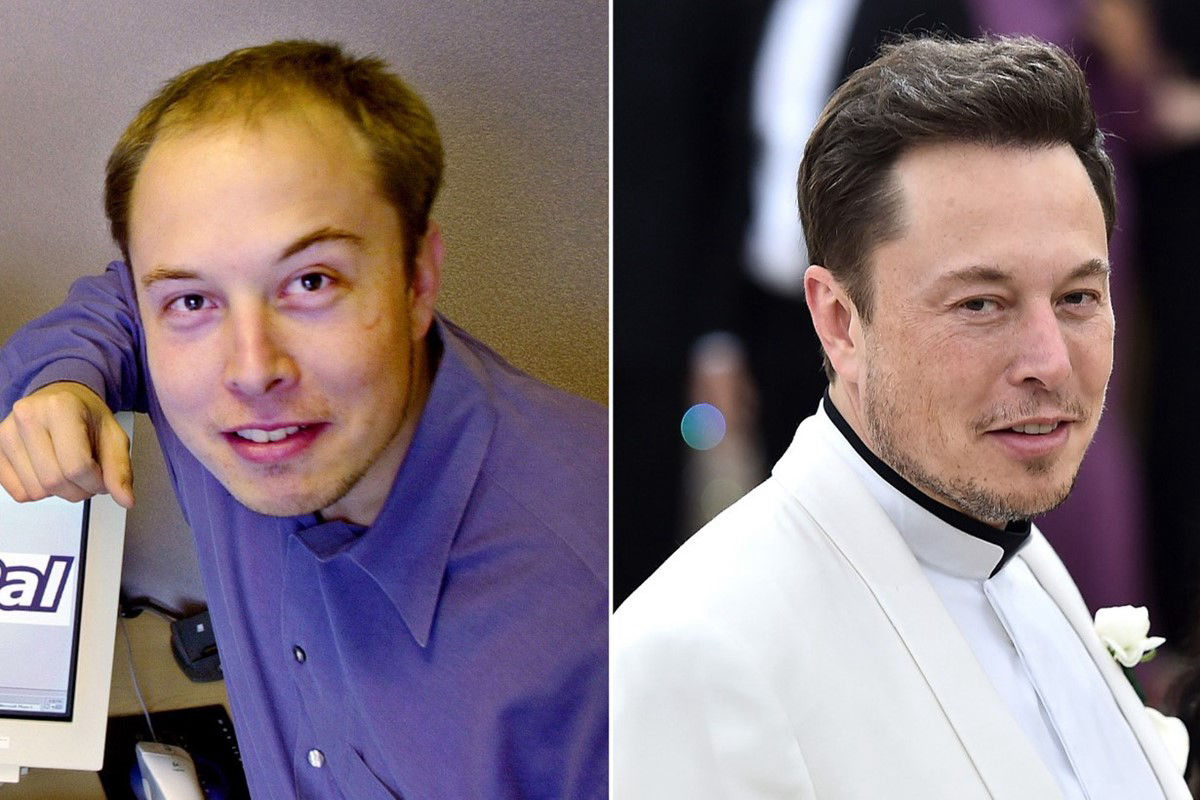 elon musk avant apres greffe de cheveux