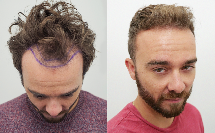 greffe de cheveux avant apres durée