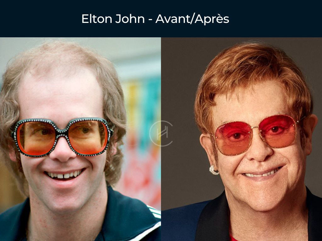 greffe de cheveux Elton John